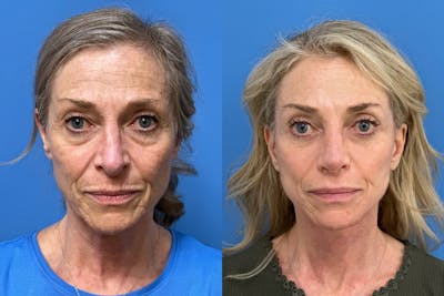 Facelift Before & After Gallery - Patient 198652 - Image 1