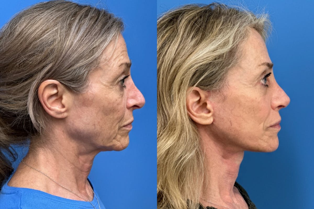 Facelift Before & After Gallery - Patient 198652 - Image 3