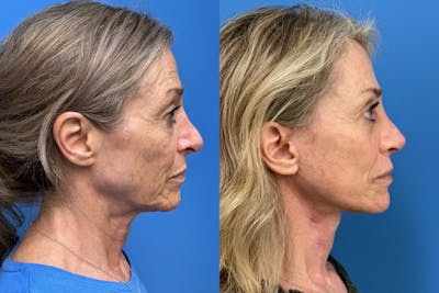 Rhinoplasty Before & After Gallery - Patient 320496 - Image 1