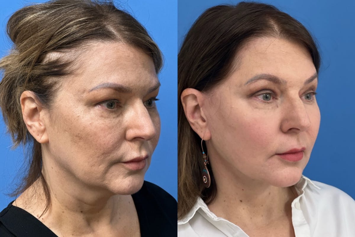Facelift Before & After Gallery - Patient 558022 - Image 2