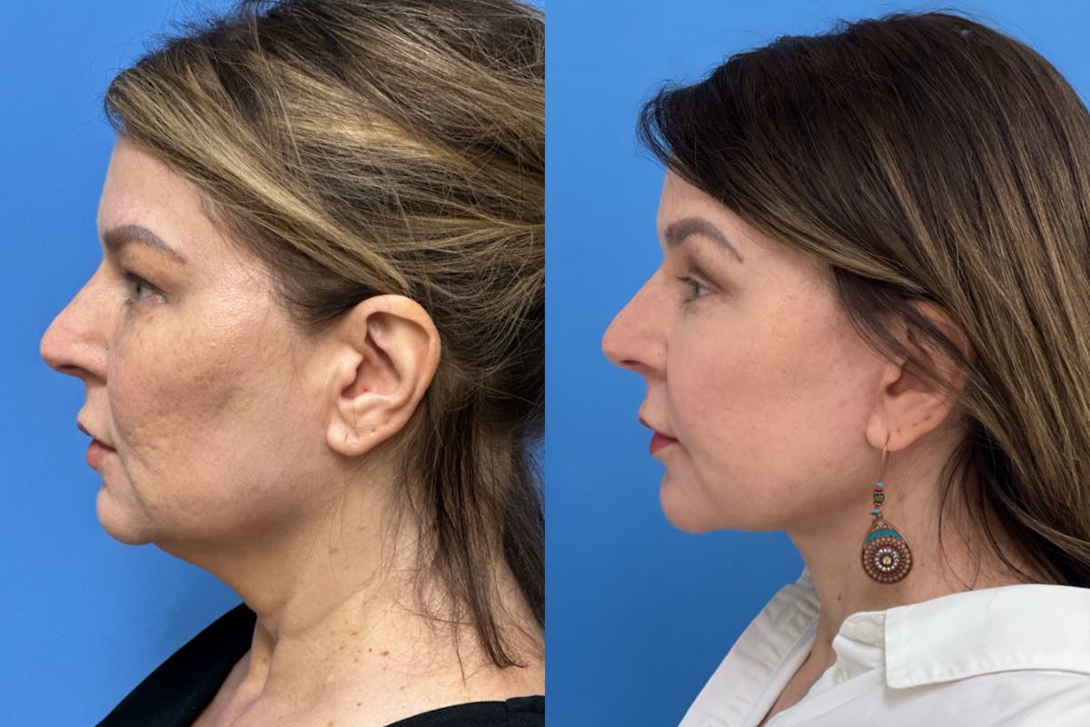 Facelift Before & After Gallery - Patient 558022 - Image 3