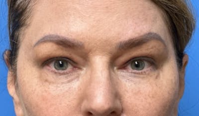 Eyelid Surgery Before & After Gallery - Patient 101024 - Image 1