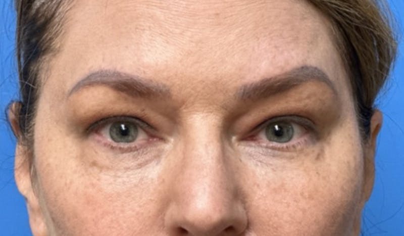 Eyelid Surgery Before & After Gallery - Patient 101024 - Image 1
