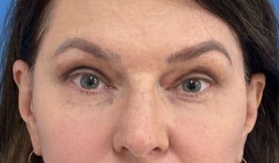 Eyelid Surgery Before & After Gallery - Patient 101024 - Image 2