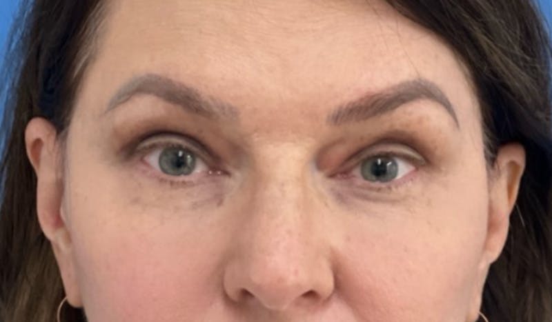 Eyelid Surgery Before & After Gallery - Patient 101024 - Image 2