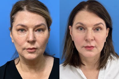 Neck Lift Before & After Gallery - Patient 204226 - Image 1