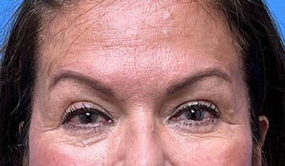 Eyelid Surgery Before & After Gallery - Patient 224557 - Image 2