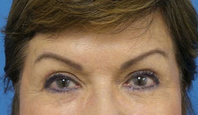 Eyelid Surgery Before & After Gallery - Patient 224557 - Image 1