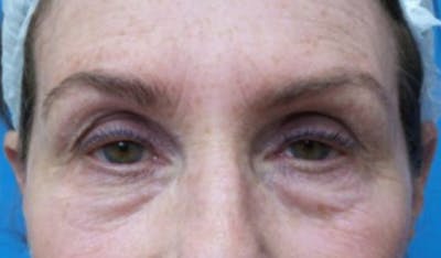 Eyelid Surgery Before & After Gallery - Patient 223243 - Image 1