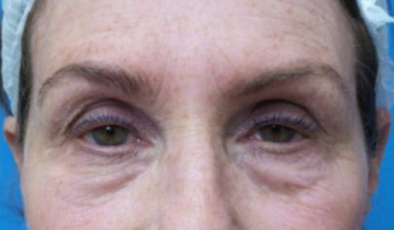 Eyelid Surgery Before & After Gallery - Patient 223243 - Image 1