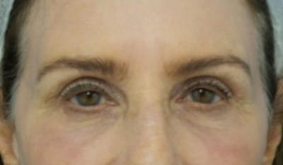 Eyelid Surgery Before & After Gallery - Patient 223243 - Image 2