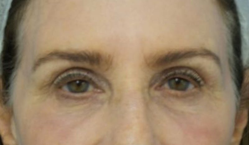 Eyelid Surgery Before & After Gallery - Patient 223243 - Image 2