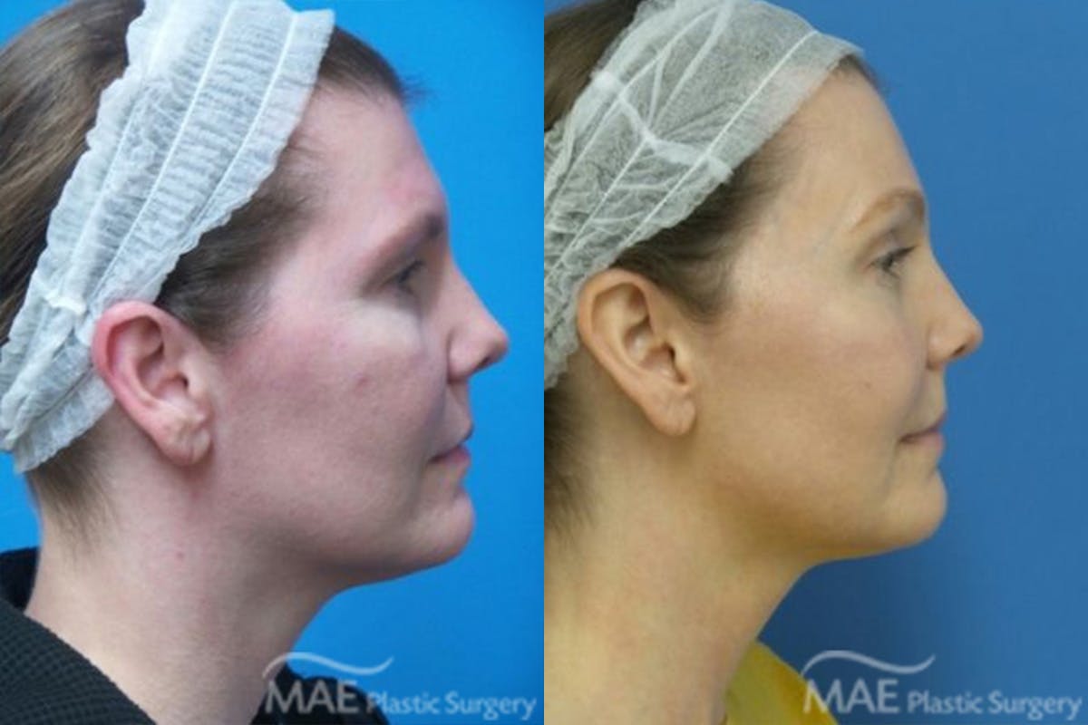 Brow Lift Before & After Gallery - Patient 239518 - Image 2