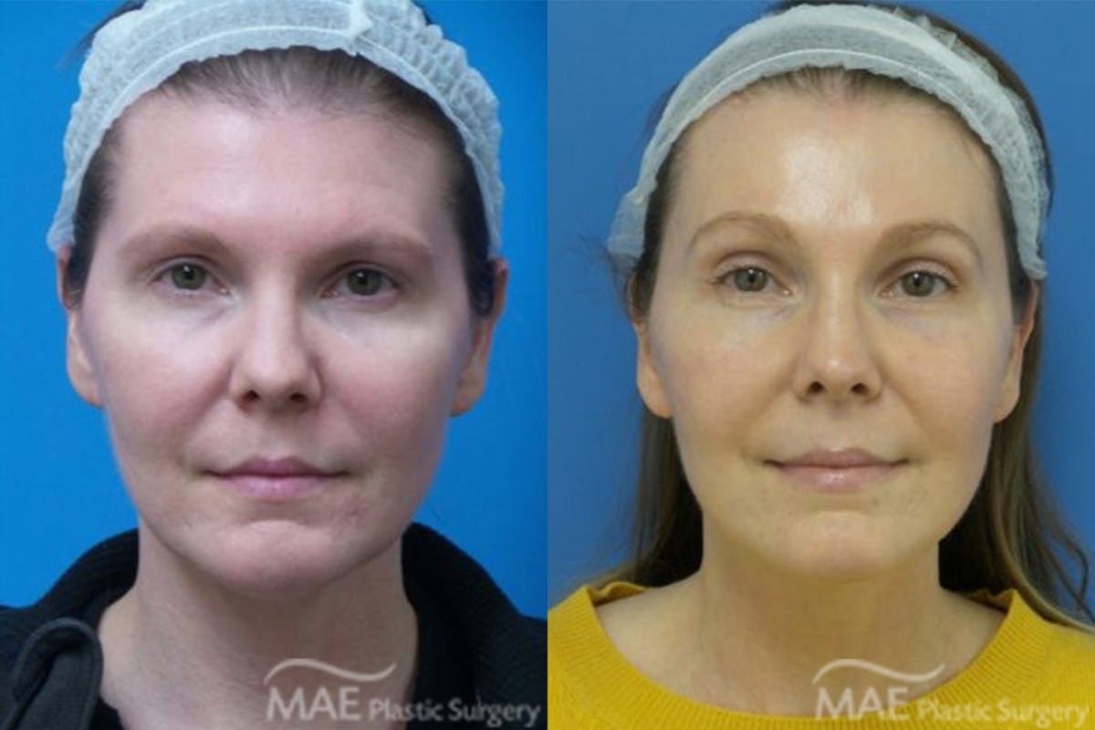 Brow Lift Before & After Gallery - Patient 239518 - Image 1
