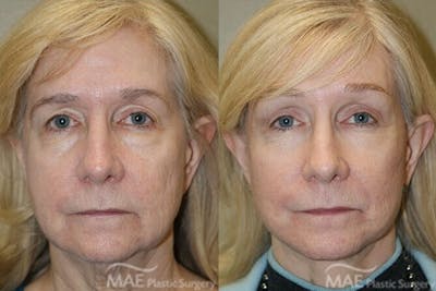 Brow Lift Before & After Gallery - Patient 268945 - Image 1
