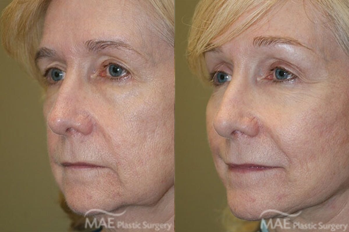 Brow Lift Before & After Gallery - Patient 268945 - Image 2