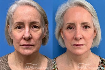 Neck Lift Before & After Gallery - Patient 364461 - Image 1