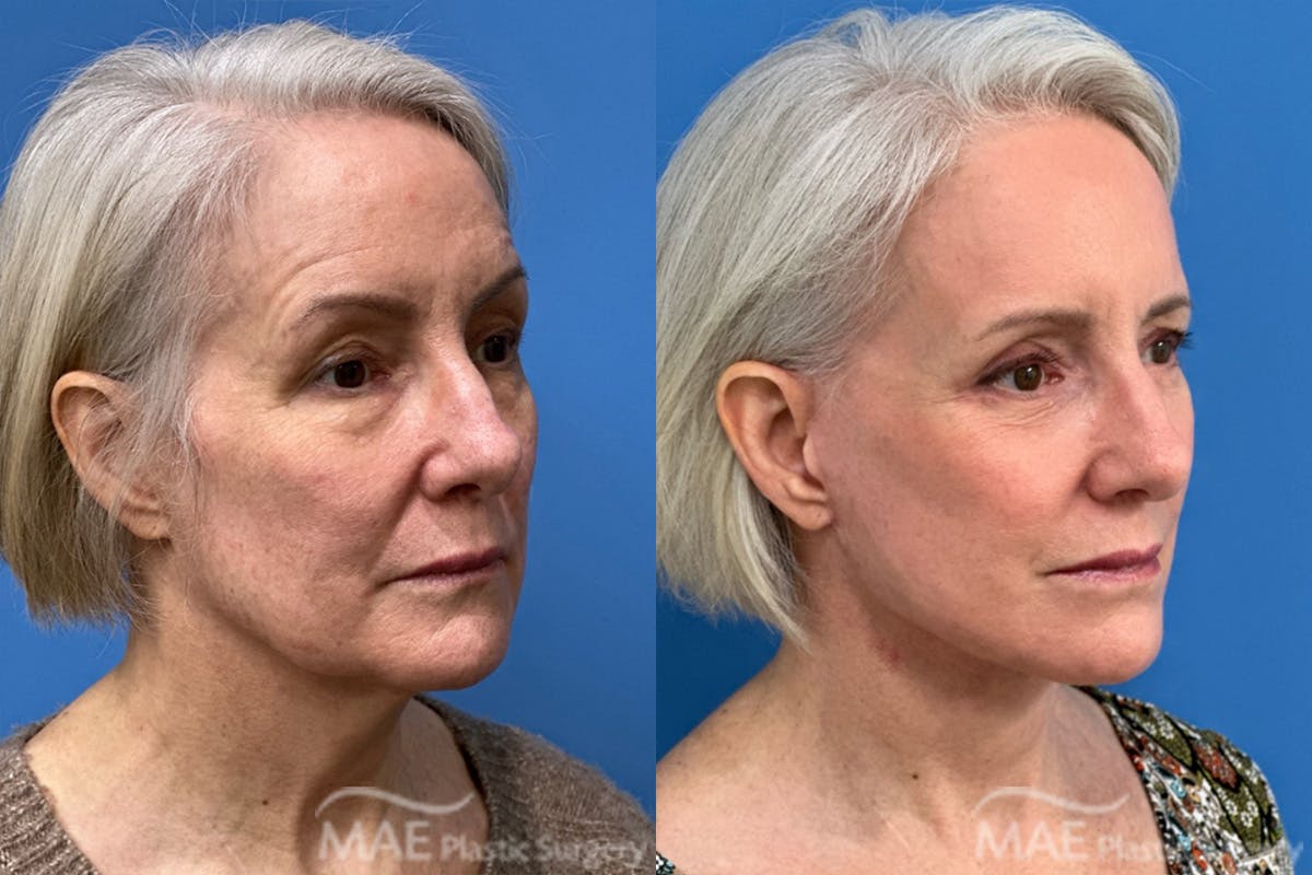 Neck Lift Before & After Gallery - Patient 364461 - Image 2