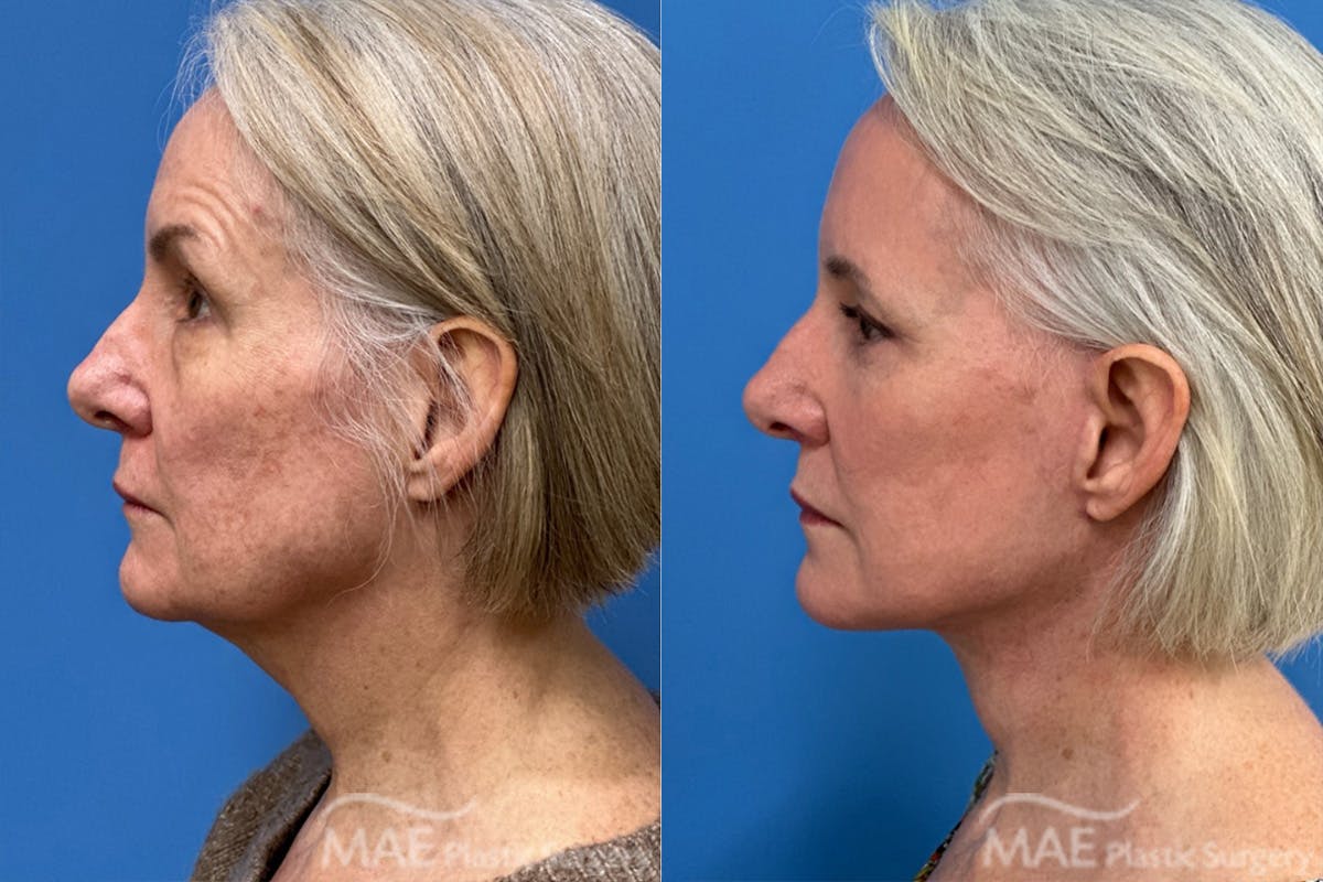 Neck Lift Before & After Gallery - Patient 364461 - Image 3