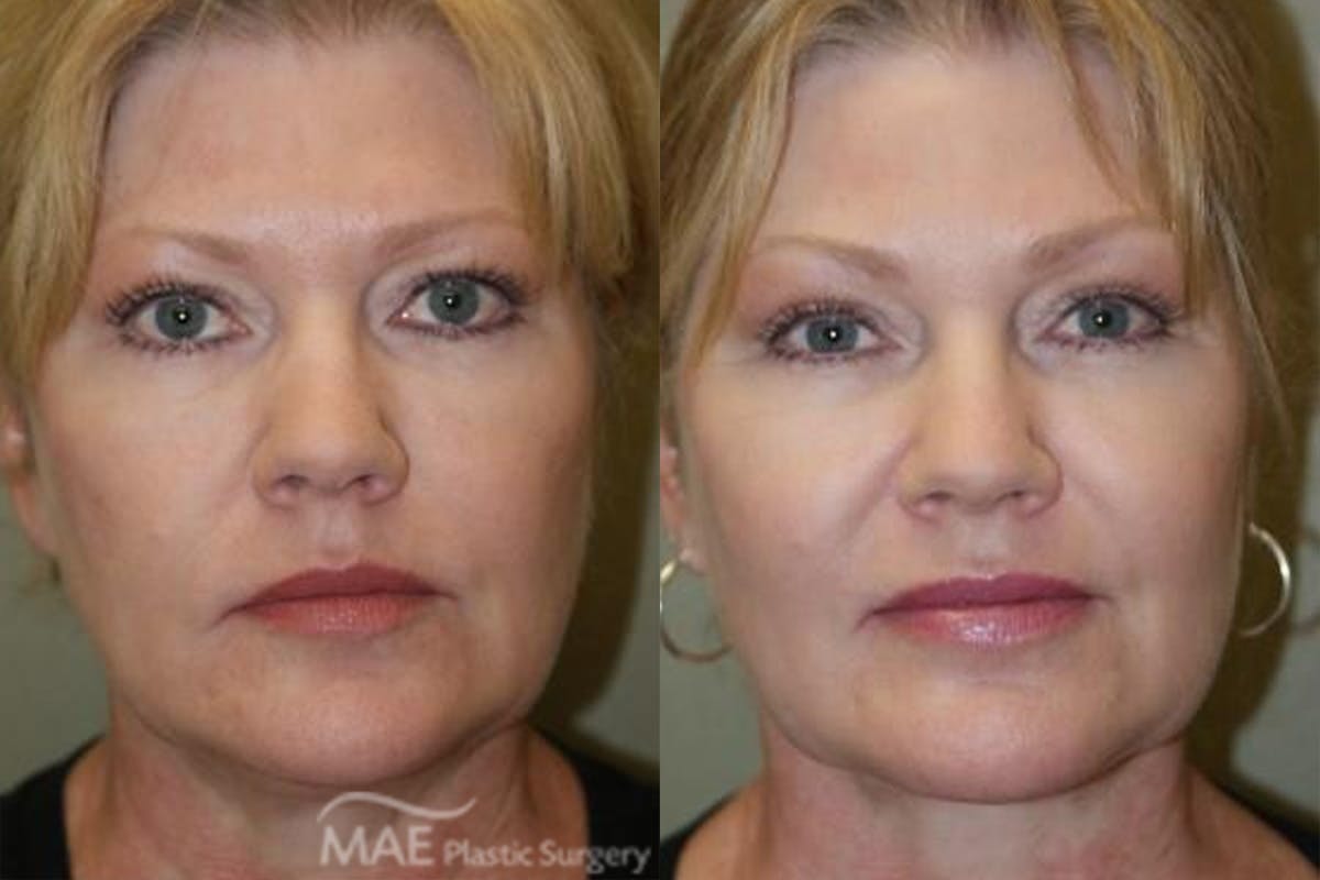 Neck Lift Before & After Gallery - Patient 213473 - Image 1