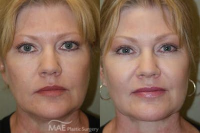 Neck Lift Before & After Gallery - Patient 213473 - Image 1