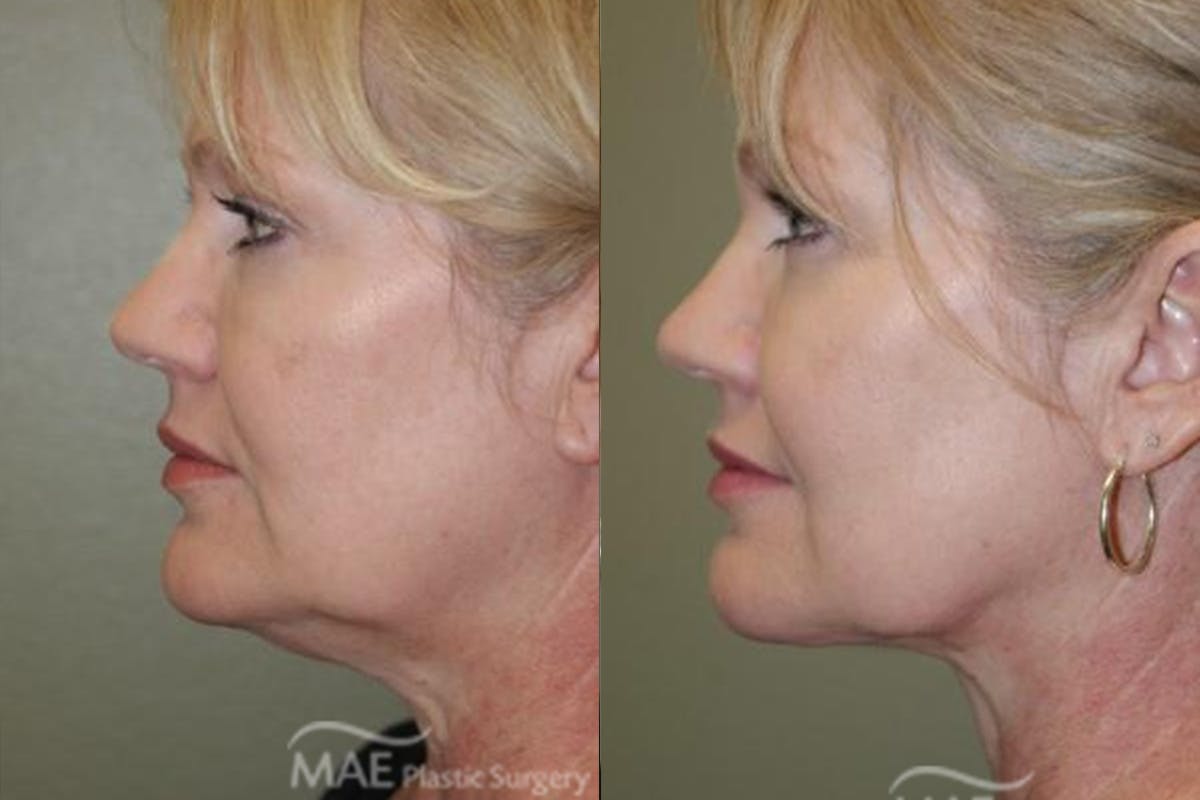 Neck Lift Before & After Gallery - Patient 213473 - Image 3