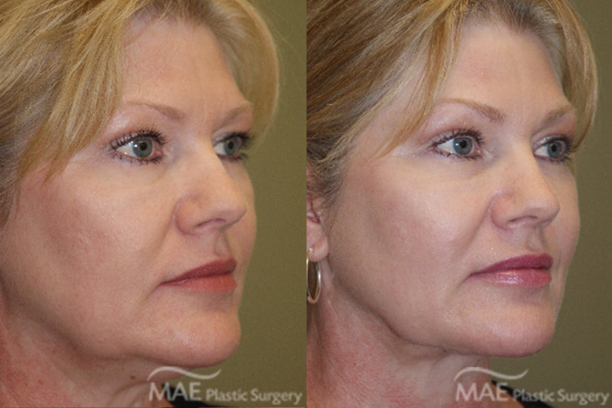Neck Lift Before & After Gallery - Patient 213473 - Image 2