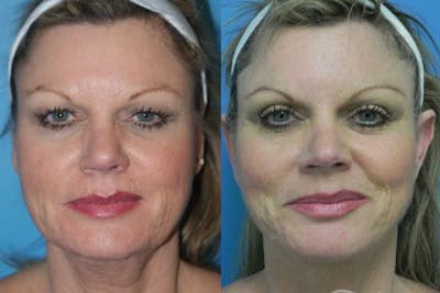 Neck Lift Before & After Gallery - Patient 158168 - Image 1