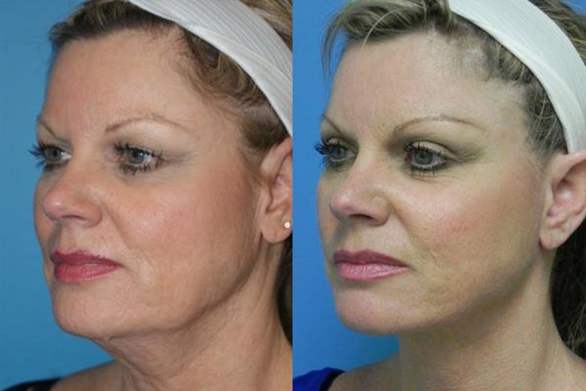 Neck Lift Before & After Gallery - Patient 158168 - Image 2
