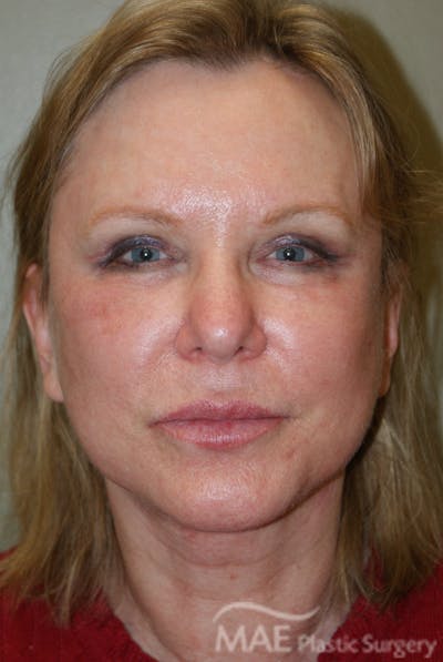 Facelift Before & After Gallery - Patient 283218 - Image 2