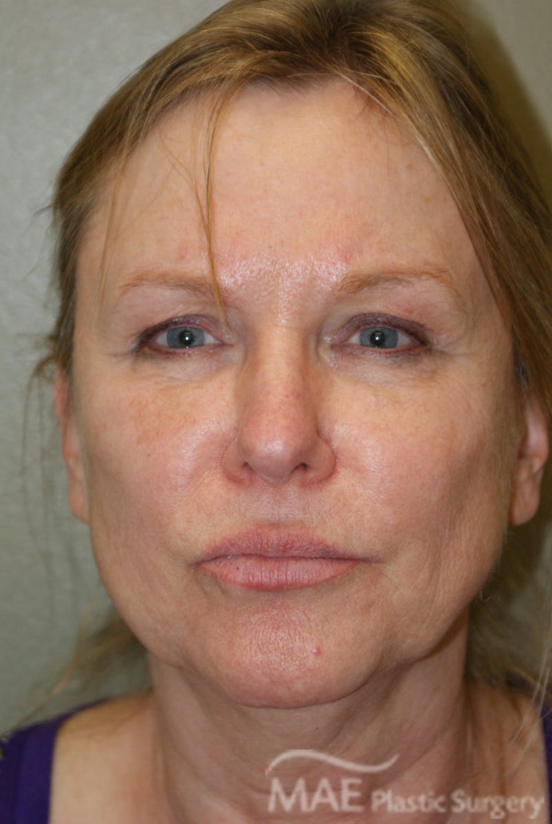 Facelift Before & After Gallery - Patient 283218 - Image 1