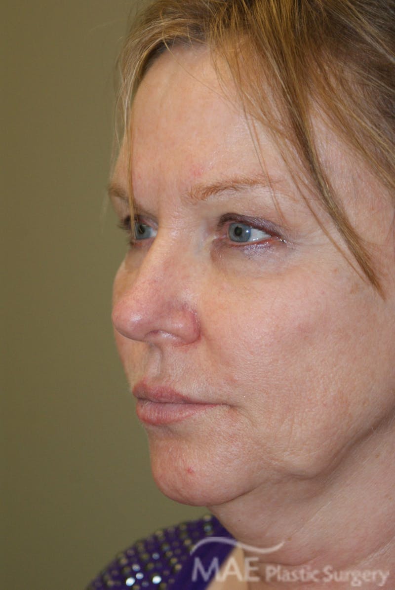 Facelift Before & After Gallery - Patient 283218 - Image 3
