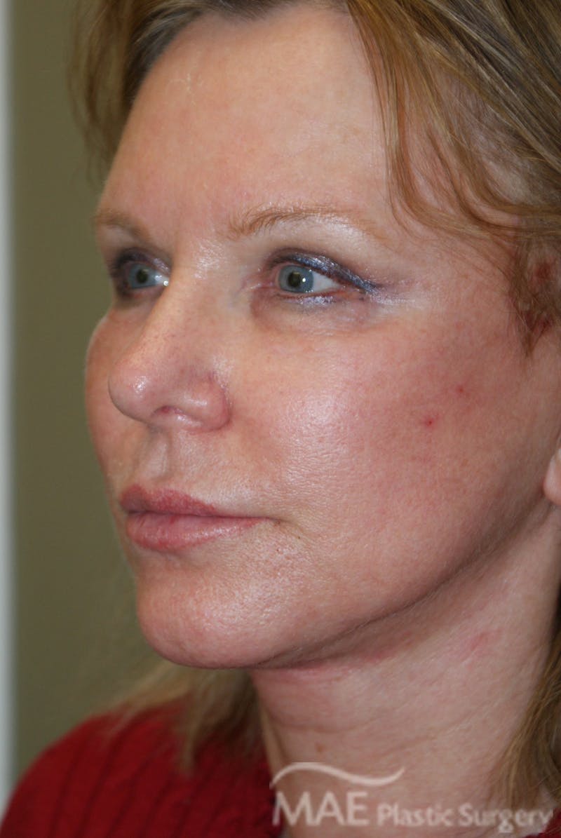 Facelift Before & After Gallery - Patient 283218 - Image 4