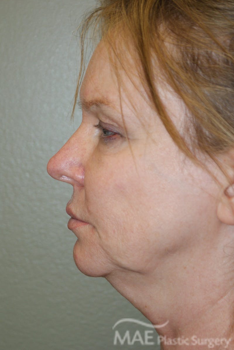 Facelift Before & After Gallery - Patient 283218 - Image 5