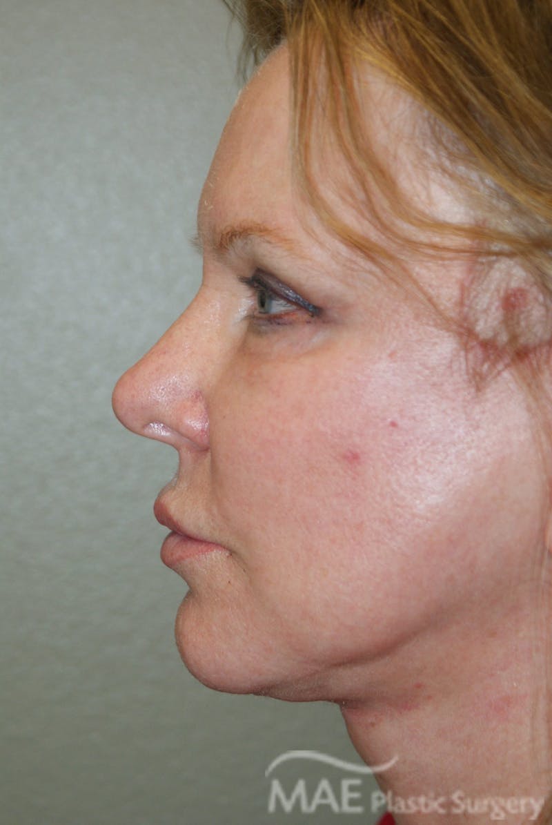 Facelift Before & After Gallery - Patient 283218 - Image 6