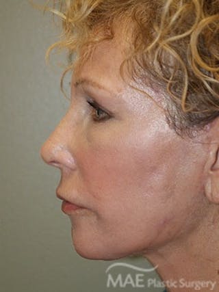 Facelift Before & After Gallery - Patient 391995 - Image 6