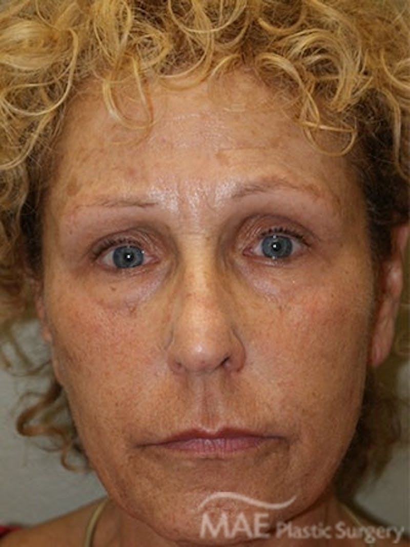 Facelift Before & After Gallery - Patient 391995 - Image 1
