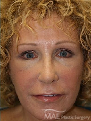 Facelift Before & After Gallery - Patient 391995 - Image 2