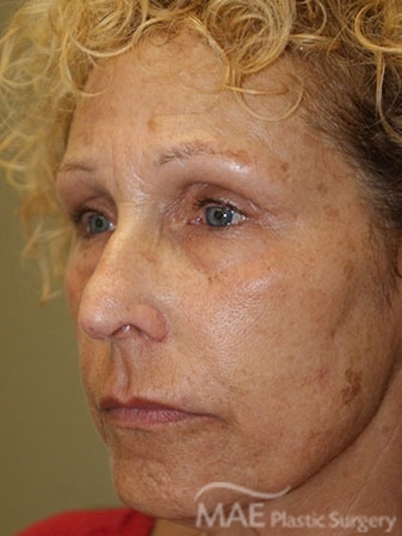 Facelift Before & After Gallery - Patient 391995 - Image 3
