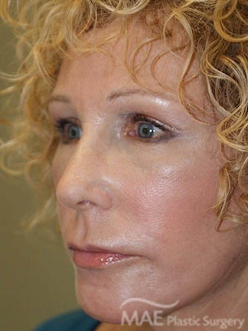Facelift Before & After Gallery - Patient 391995 - Image 4