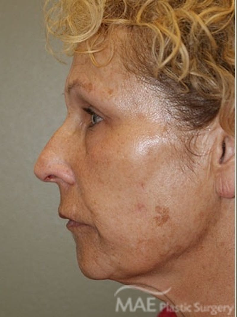 Facelift Before & After Gallery - Patient 391995 - Image 5