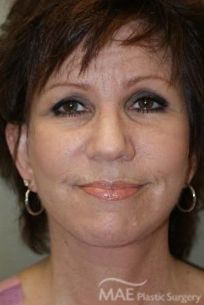 Facelift Before & After Gallery - Patient 224763 - Image 2