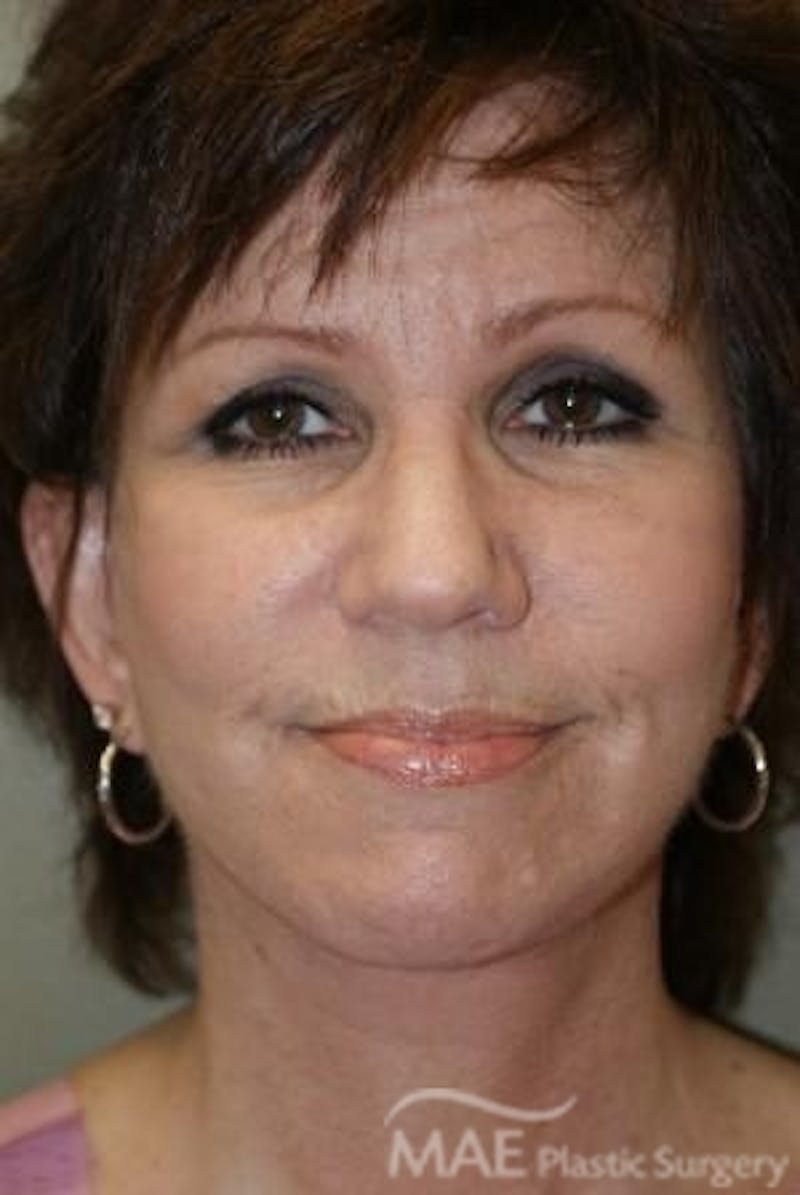 Facelift Before & After Gallery - Patient 224763 - Image 2