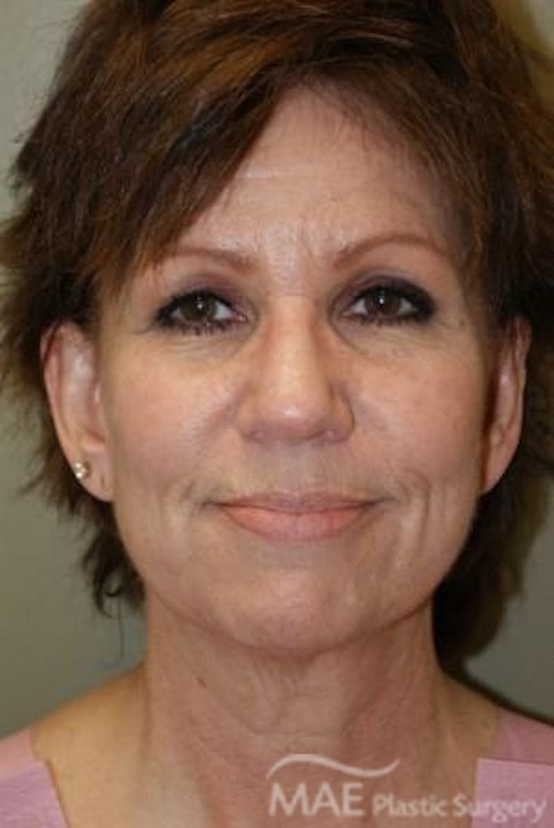 Facelift Before & After Gallery - Patient 224763 - Image 1