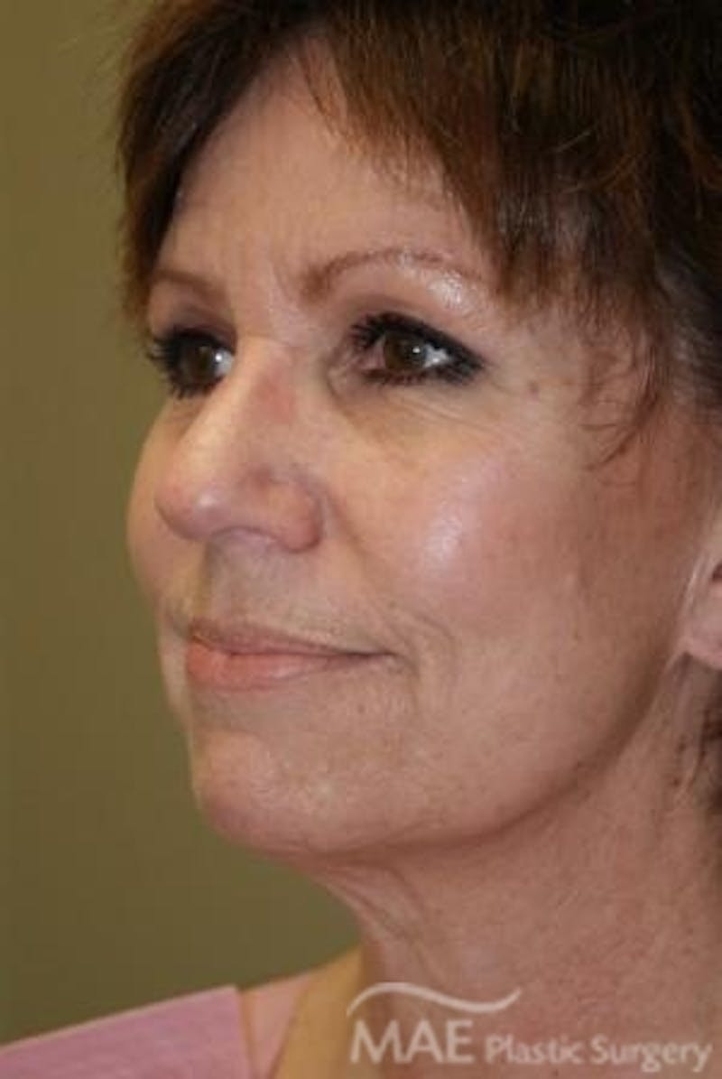 Facelift Before & After Gallery - Patient 224763 - Image 3