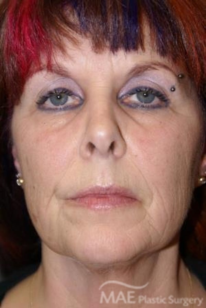 Facelift Before & After Gallery - Patient 340708 - Image 1