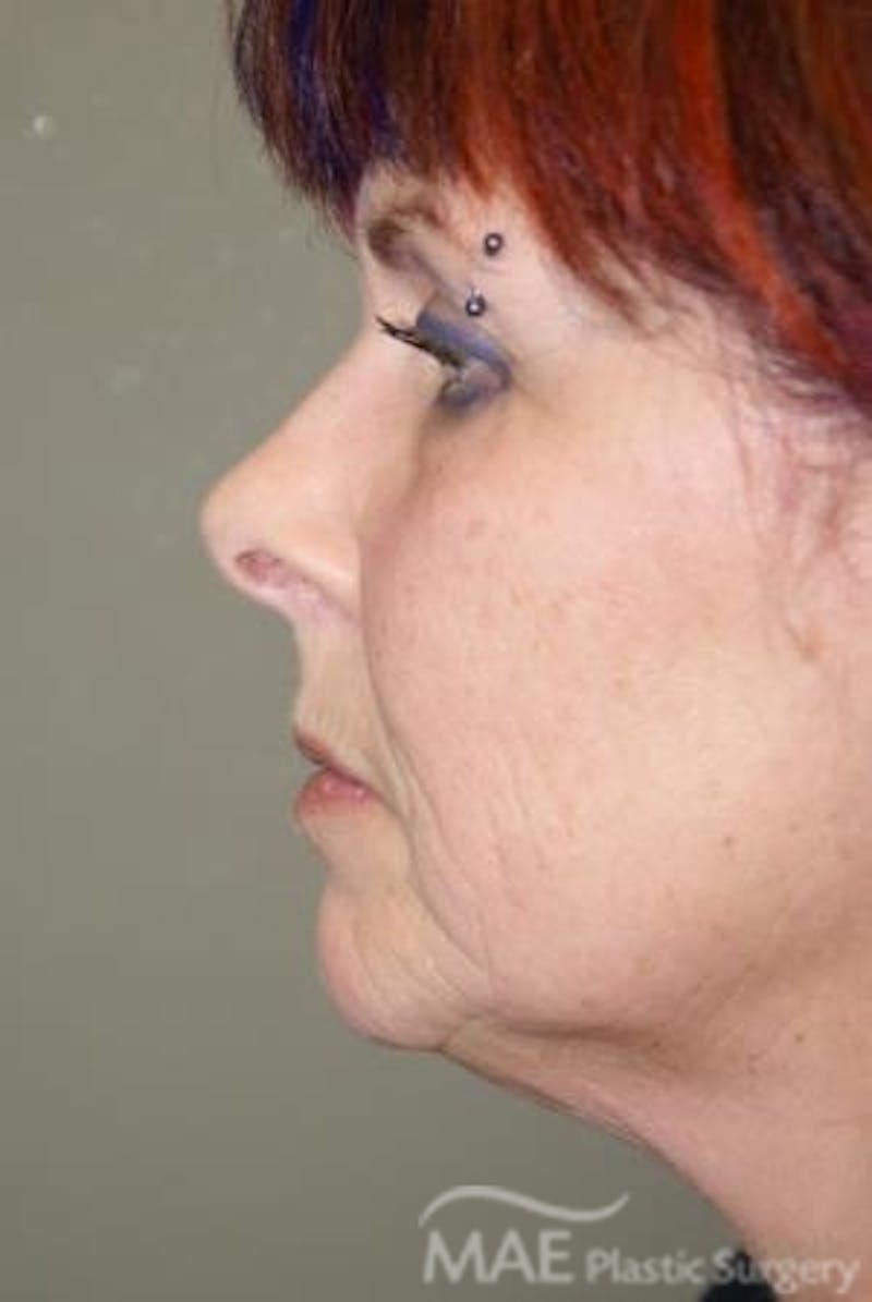 Facelift Before & After Gallery - Patient 340708 - Image 5