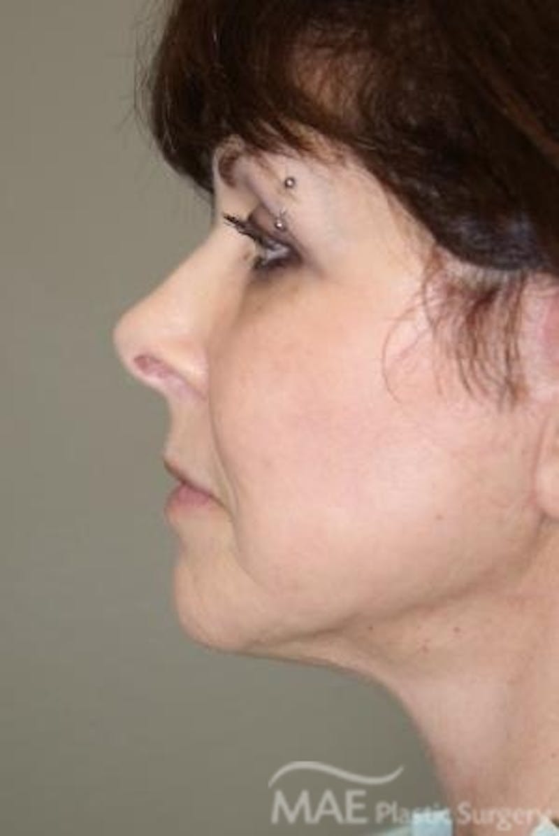 Facelift Before & After Gallery - Patient 340708 - Image 6