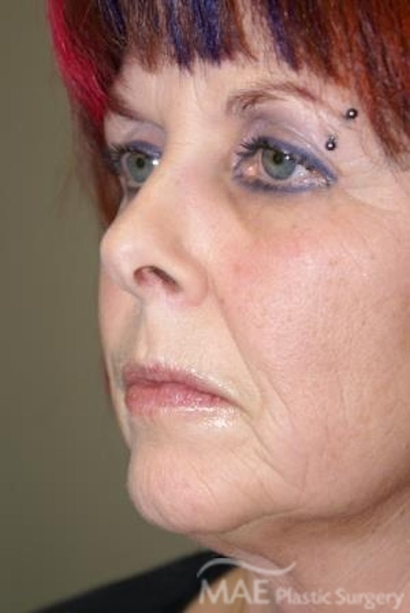 Facelift Before & After Gallery - Patient 340708 - Image 3