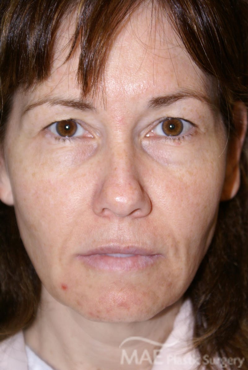 Facelift Before & After Gallery - Patient 164529 - Image 1